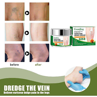 Buy Guanjing Varicose Vein Cream in Kenya – Reduce Spider Veins & Improve Circulation | Platinum Store KE