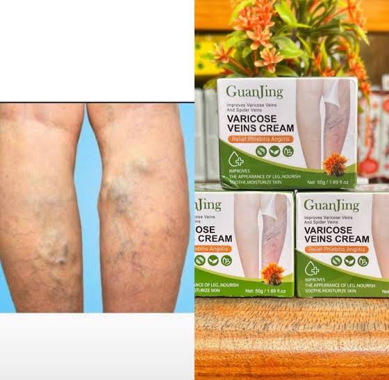 Buy Guanjing Varicose Vein Cream in Kenya – Reduce Spider Veins & Improve Circulation | Platinum Store KE